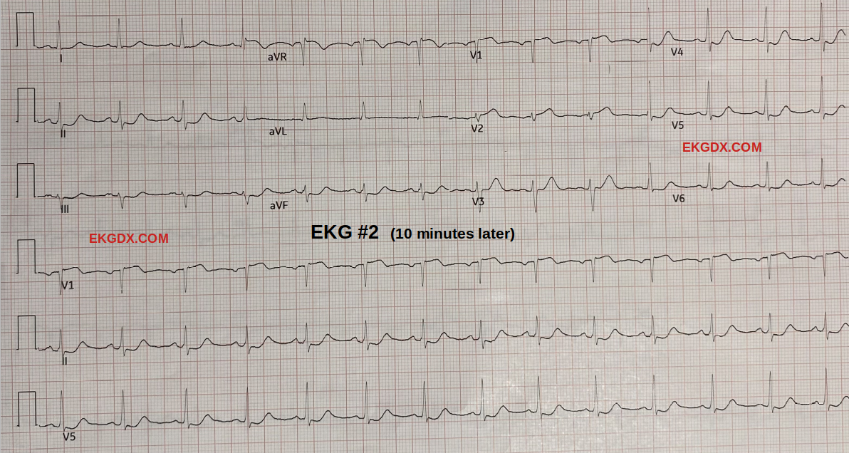 健康・医学 The Ecg in Acute Mi Anterior Myocardial Infarction • LITFL • ECG Library Diagnosis